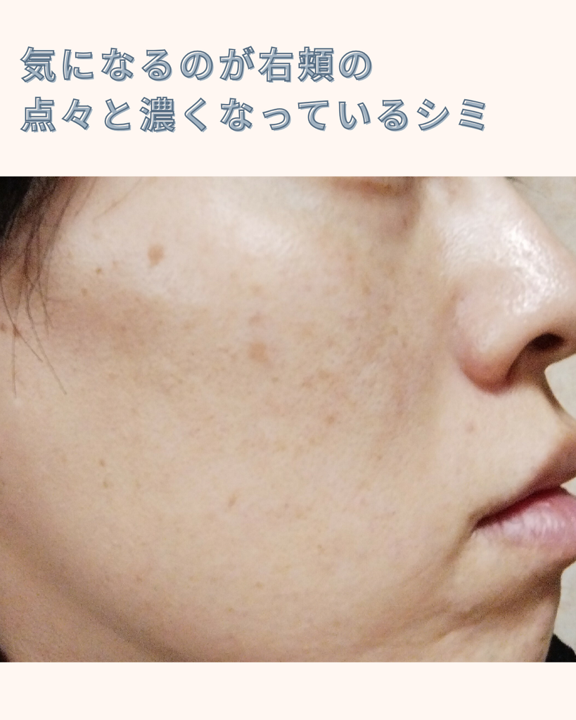 【実体験】デュアルピール10回の経過｜シミ・毛穴・くすみの変化を写真で比較