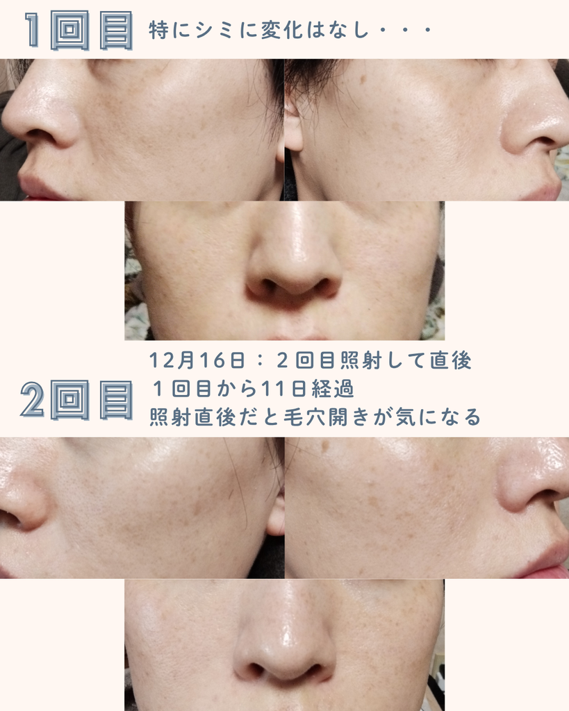【実体験】デュアルピール10回の経過｜シミ・毛穴・くすみの変化を写真で比較