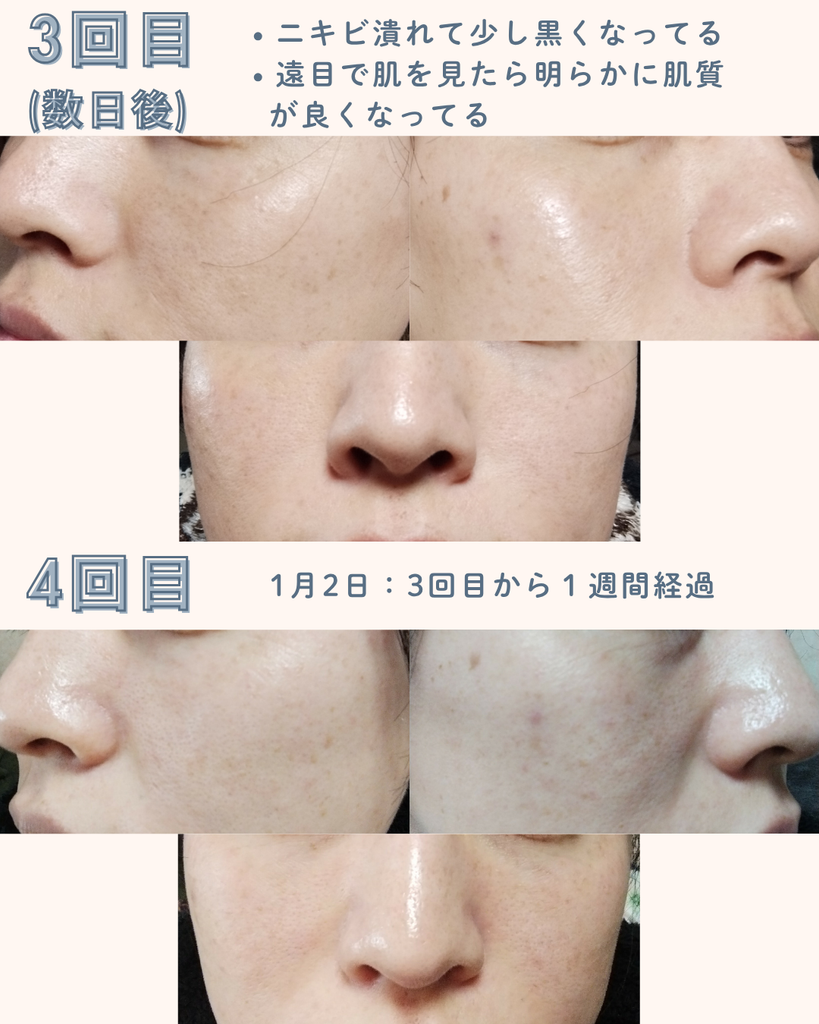 【実体験】デュアルピール10回の経過｜シミ・毛穴・くすみの変化を写真で比較