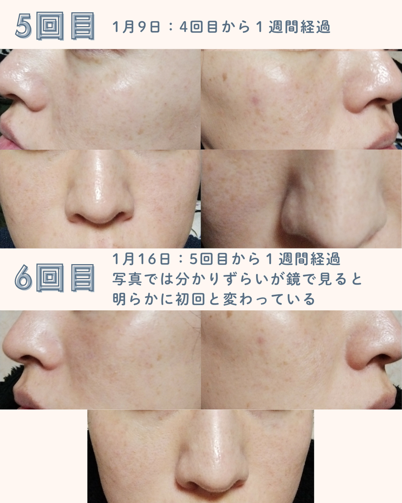 【実体験】デュアルピール10回の経過｜シミ・毛穴・くすみの変化を写真で比較