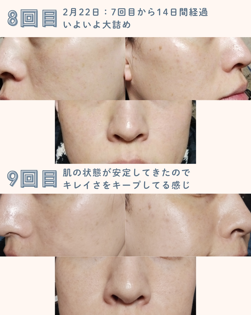 【実体験】デュアルピール10回の経過｜シミ・毛穴・くすみの変化を写真で比較