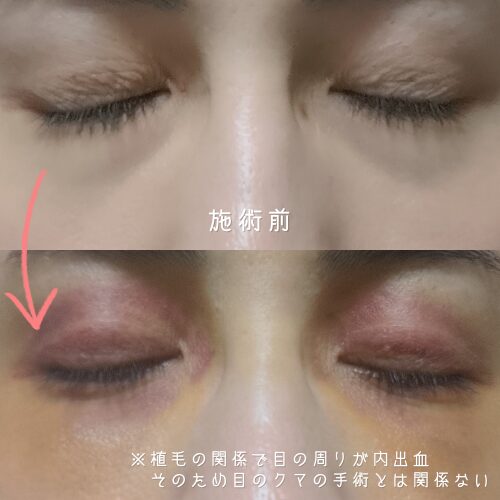 【写真あり】裏ハムラ1ヶ月経過レポ【目のクマが薄くなったリアル体験】