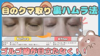 【写真あり】裏ハムラ1ヶ月経過レポ【目のクマが薄くなったリアル体験】