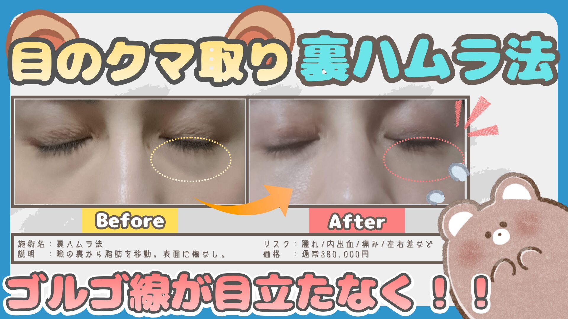 【写真あり】裏ハムラ1ヶ月経過レポ【目のクマが薄くなったリアル体験】