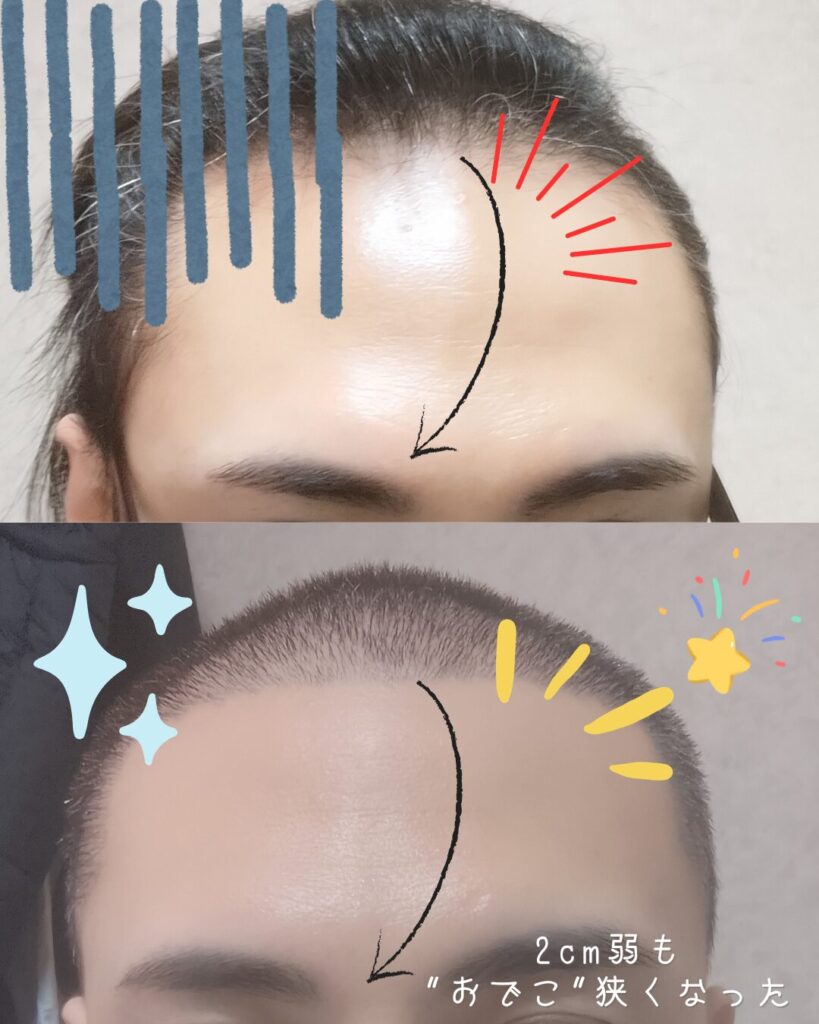 自毛植毛手術前の生え際とM字部分の薄毛の状態