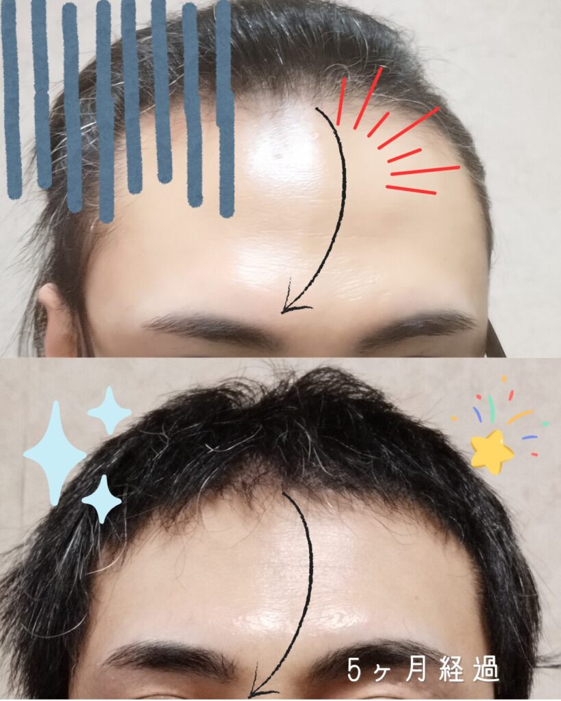 自毛植毛で約2cmおでこが狭くなった術前と術後5ヶ月目の比較写真