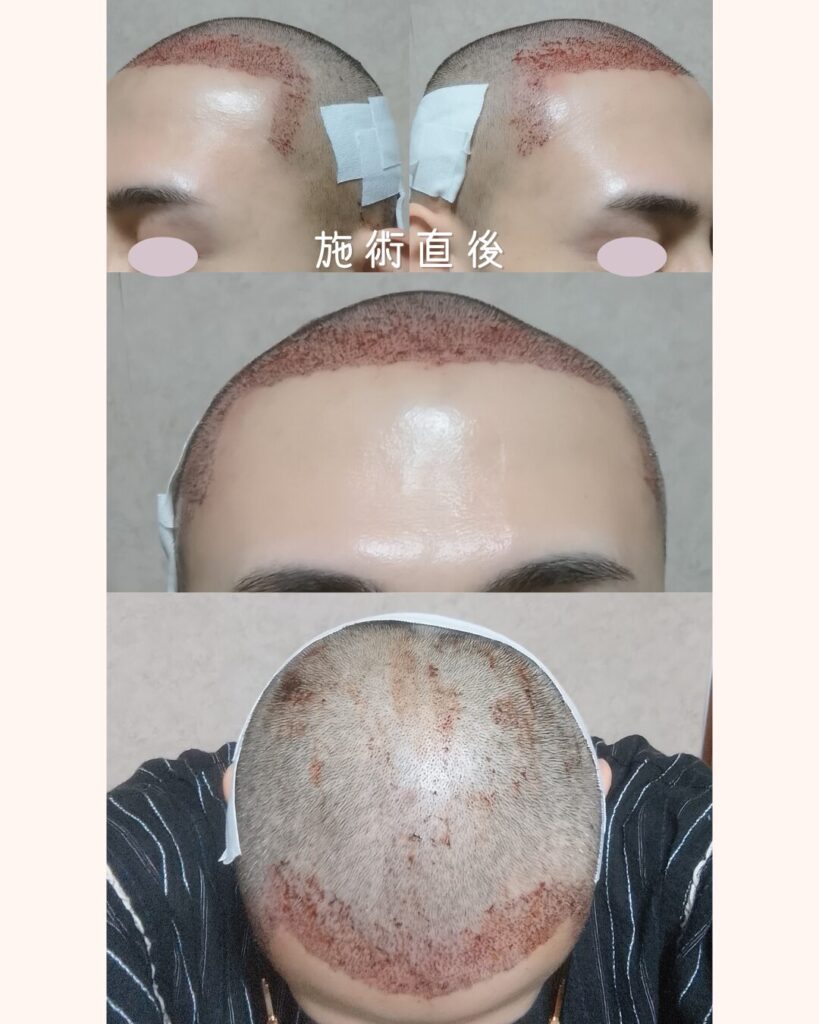 自毛植毛手術の直後。頭皮に赤みがある状態の写真