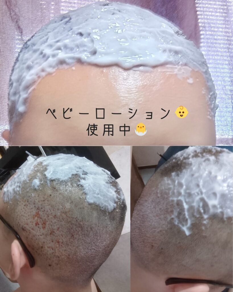 植毛術後1日目、かさぶたをふやかすためのベビーローションと霧吹きでのケア