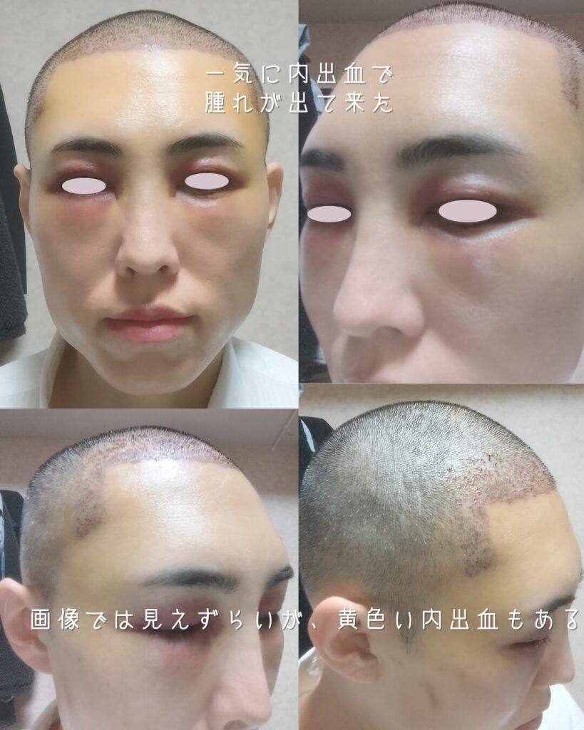 植毛術後1日目から続くダウンタイム。おでことこめかみがパンパンに腫れる経過の定点観測