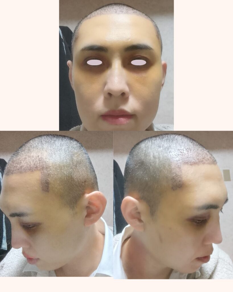 自毛植毛から4日〜6日後。目の周りに黄色い内出血や腫れが出ているダウンタイムの様子