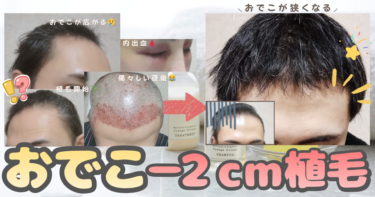 【植毛5ヶ月更新】自毛植毛で人生を変える1年間の記録｜後悔しない「正しい洗い方」の重要性