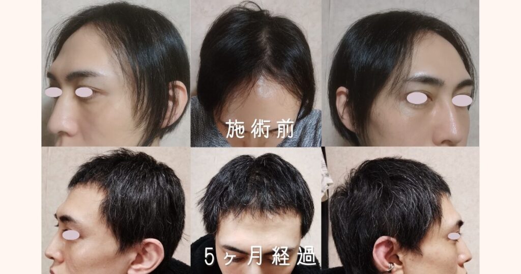自毛植毛から5ヶ月が経過し、移植した毛がしっかりと生え揃ってきた様子
