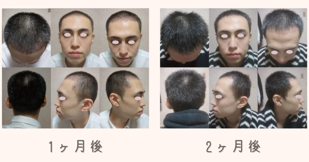 自毛植毛後1ヶ月から2ヶ月が経過し、後頭部のドナー採取部分の髪が伸びてきた様子