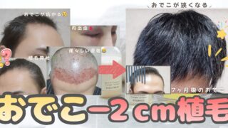 【植毛7ヶ月経過】8ヶ月目突入！バレない自然な生え際とリアルな現状
