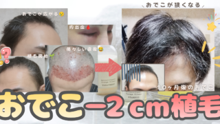 【自毛植毛10ヶ月経過】11ヶ月目に突入｜おでこ−2cmの密度・赤み・ザラつきを写真で公開