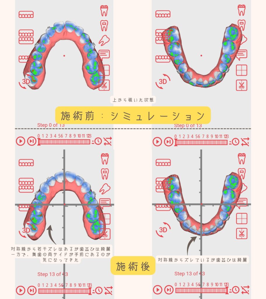Oh my teethの3Dシミュレーション正面画像。施術前と13週間（約3ヶ月）経過後の歯並びの比較。すきっ歯が改善されているが正中線は完全には一致しない結果。
