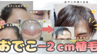 自毛植毛1年後｜おでこはどう変わった？写真で振り返る体験談