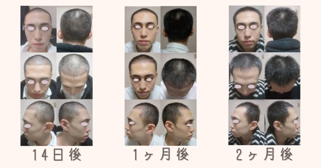 自毛植毛の手術後14日後、1ヶ月後、2ヶ月後の一時的な抜け毛期と頭皮環境
