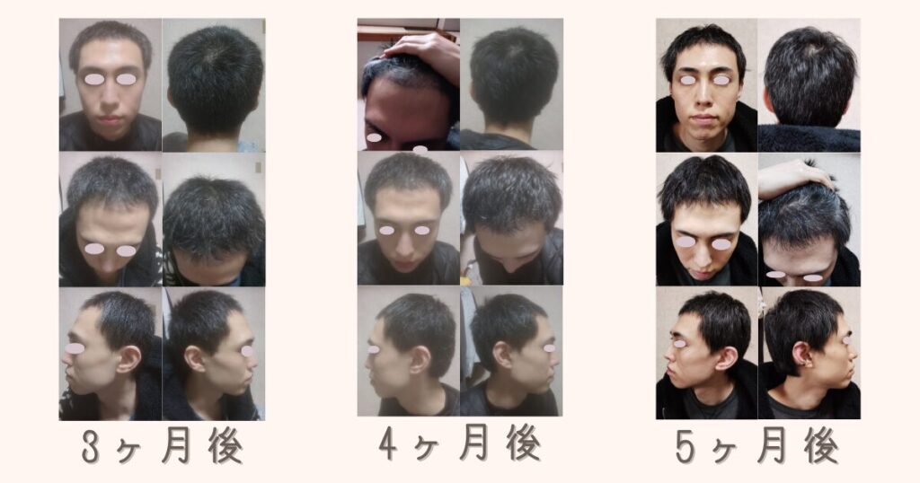 自毛植毛の手術後3ヶ月後、4ヶ月後、5ヶ月後の発毛の兆しとM字部分の毛量変化