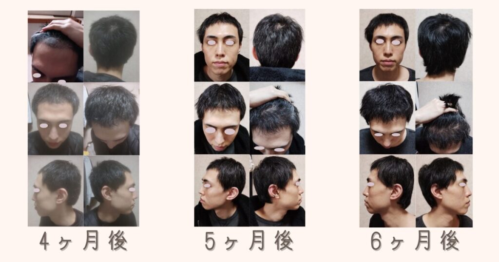 自毛植毛の手術後4ヶ月後、5ヶ月後、6ヶ月後の髪の密度アップと毛質の変化