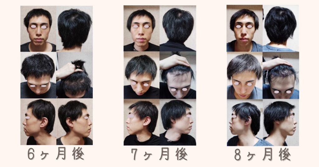 自毛植毛の手術後4ヶ月後、5ヶ月後、6ヶ月後の髪の密度アップと毛質の変化