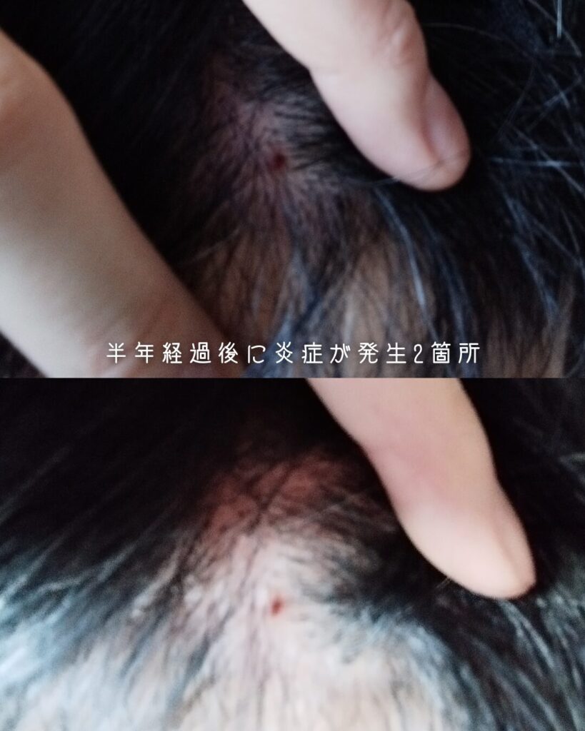 炎症の写真を配置。代替テキスト:自毛植毛の手術から7ヶ月経過後、おでこの生え際に発生した炎症とかさぶたの様子