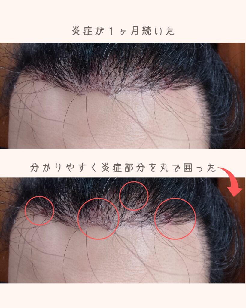 自毛植毛から9ヶ月経過後、生え際に発生したニキビのような炎症と赤みの様子