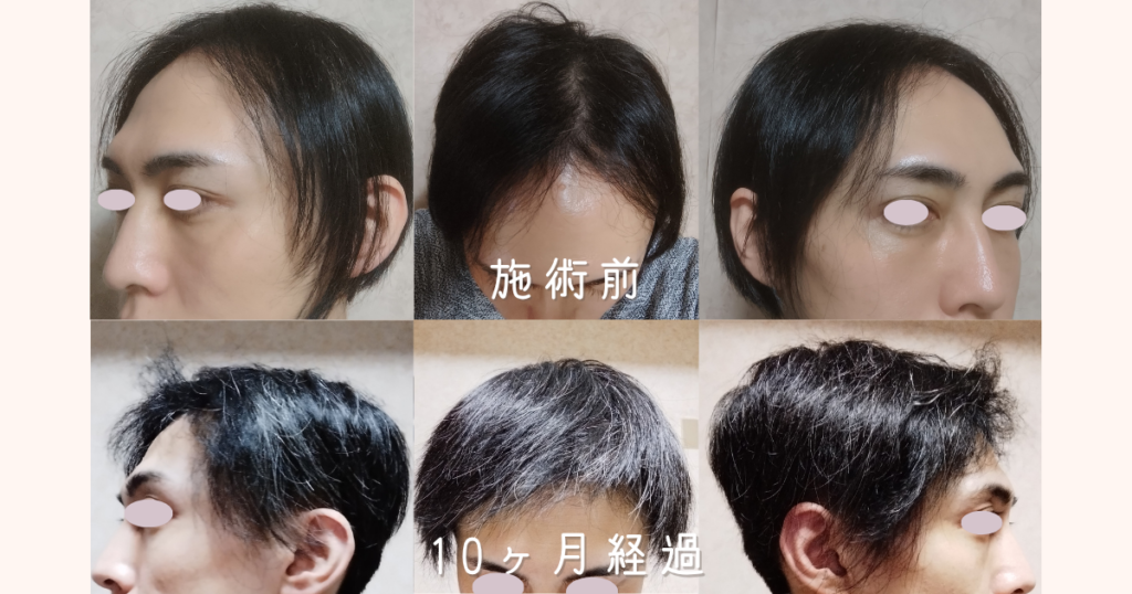 自毛植毛の手術前から9ヶ月経過後までの頭頂部・左右の生え際・正面のビフォーアフター比較写真