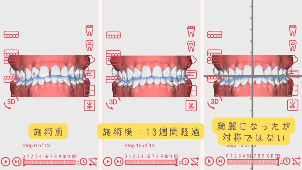 Oh my teethの3Dシミュレーション正面画像。施術前と13週間（約3ヶ月）経過後の歯並びの比較。すきっ歯が改善されているが正中線は完全には一致しない結果。