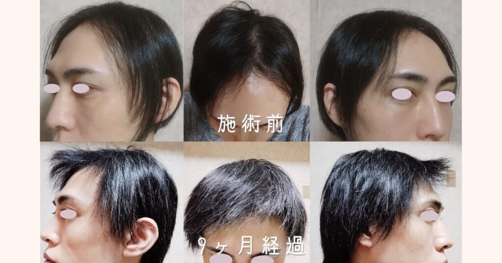 自毛植毛の手術前から9ヶ月経過後までの頭頂部・左右の生え際・正面のビフォーアフター比較写真