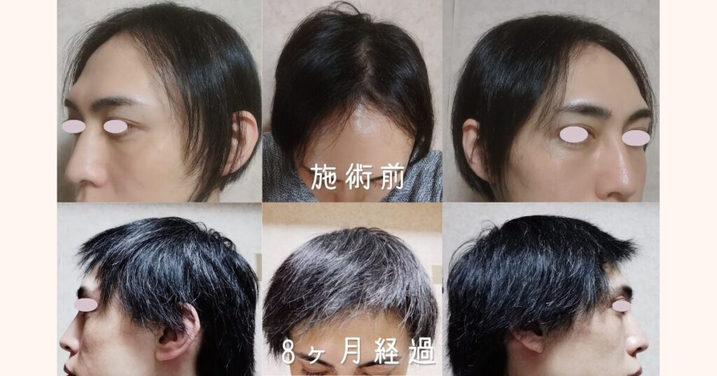 自毛植毛の手術前から8ヶ月経過後までの頭頂部・左右の生え際・正面のビフォーアフター比較写真