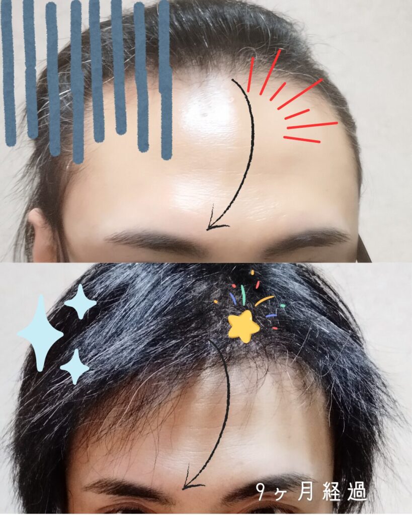 自毛植毛手術前の生え際とM字部分の薄毛の状態