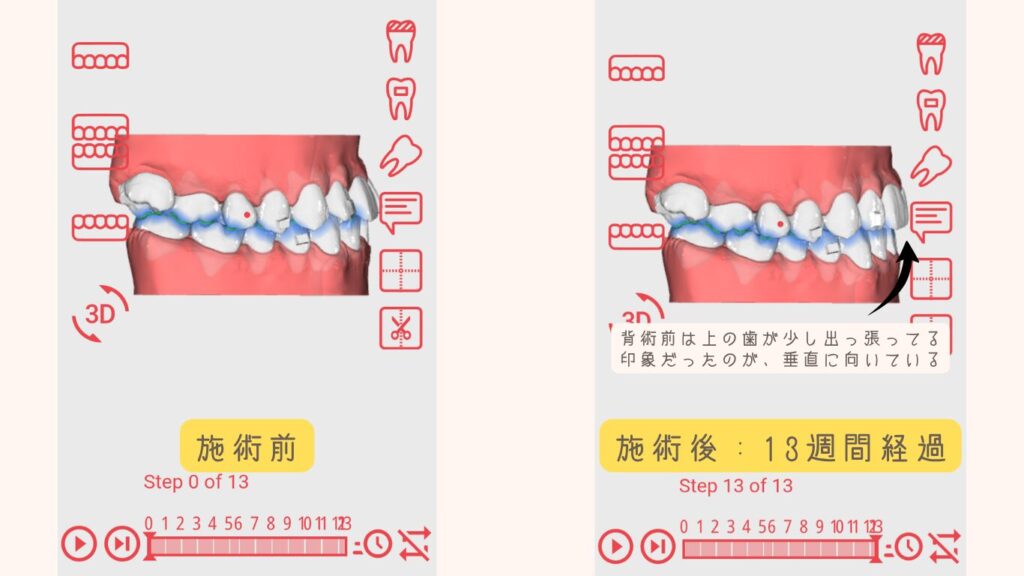 Oh my teethの3Dシミュレーション横顔アングルの比較。上の前歯の出っ張りが13週間で垂直に改善されるシミュレーション結果。