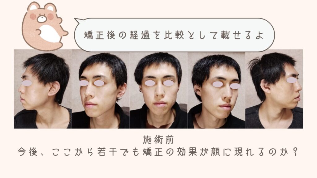 マウスピース矯正開始前（39歳）の顔写真5アングル。今後、前歯が下がることで顔の印象やEラインがどう変化するかを比較予定。