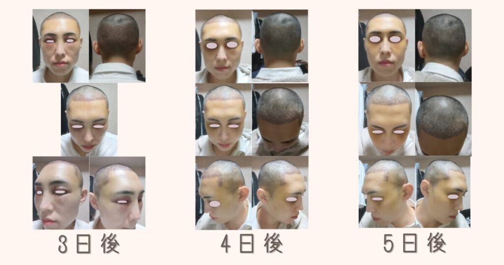 自毛植毛の手術後3日後、4日後、5日後のまぶたやおでこの腫れ・経過写真