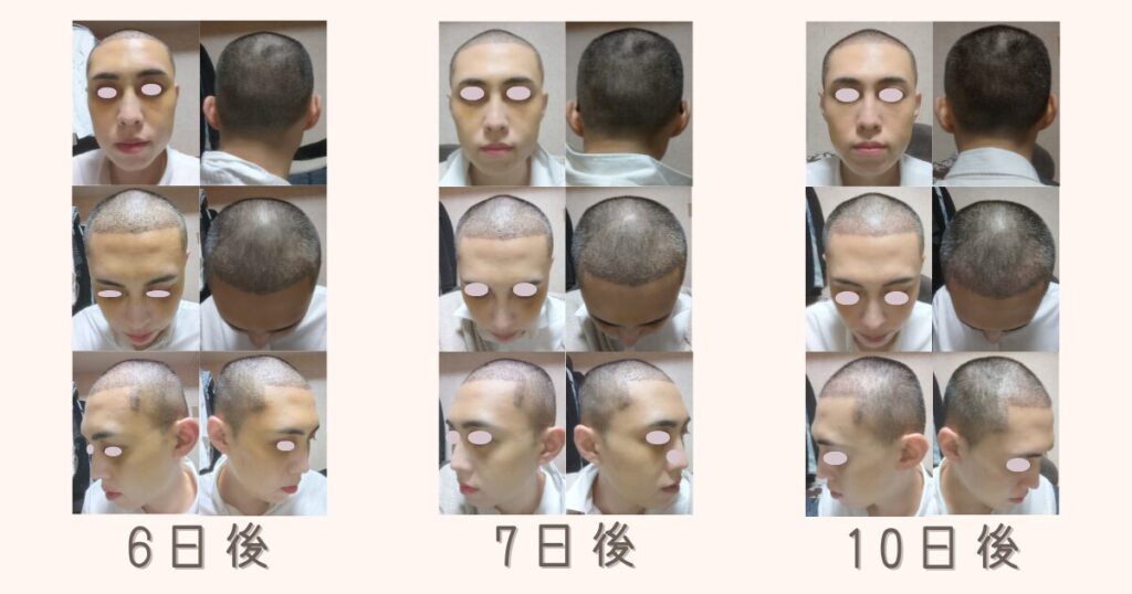 自毛植毛の手術後6日後、7日後、10日後の生え際のかさぶたと頭皮の状況