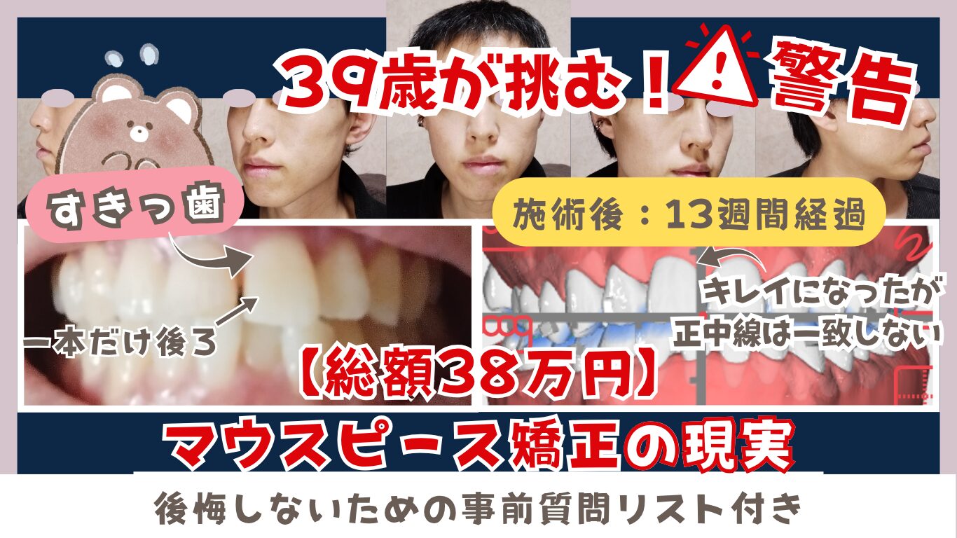 【更新型：0ヶ月目】マウスピース矯正の現実 → 39歳が挑むOh my teeth【体験談】