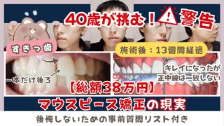 【更新型:2ヶ月目】大人のマウスピース歯列矯正の現実【体験談】