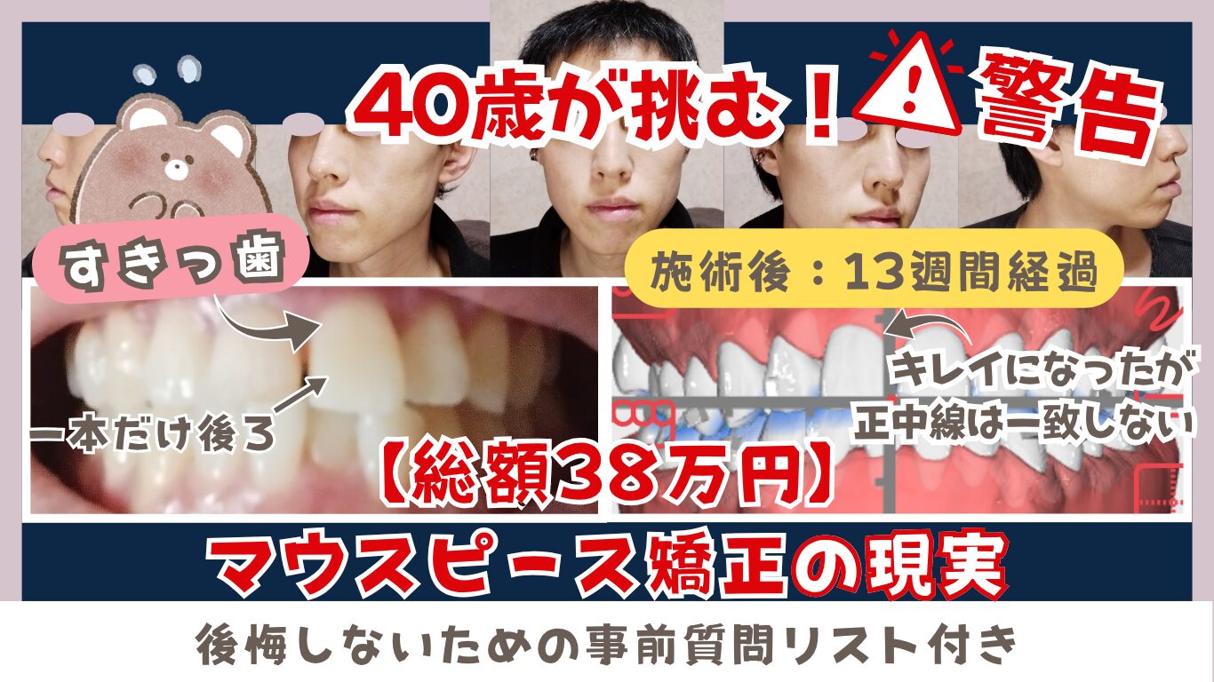 40歳が挑むマウスピース矯正の現実。総額38万円のビフォーアフター（すきっ歯改善・正中線のズレ）と、後悔しないための事前質問リスト。