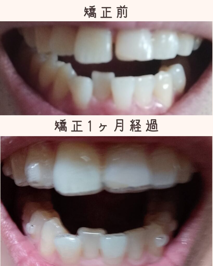 マウスピース矯正前と矯正1ヶ月後