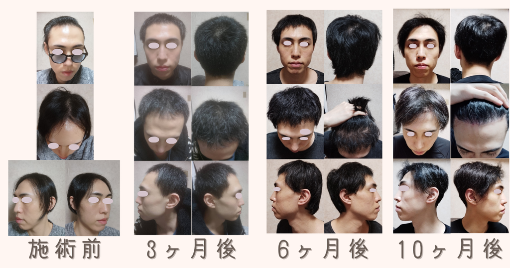 植毛前→3ヶ月→6ヶ月→10ヶ月の4枚比較
