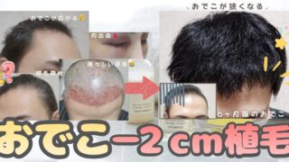 【植毛6ヶ月経過】バレない自然な生え際に！おでこ-2cmキープのリアル