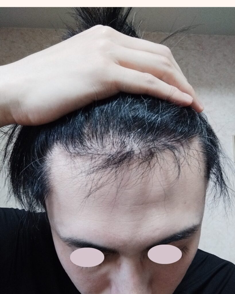 前髪をかき上げた写真を配置。代替テキスト:植毛から7ヶ月経過後、前髪をかき上げた際のリアルな地肌の透け感