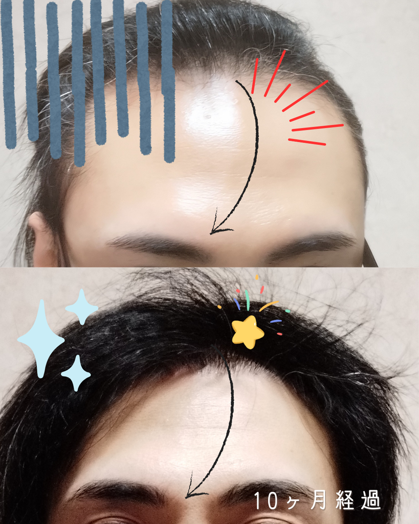 自毛植毛手術前の生え際とM字部分の薄毛の状態