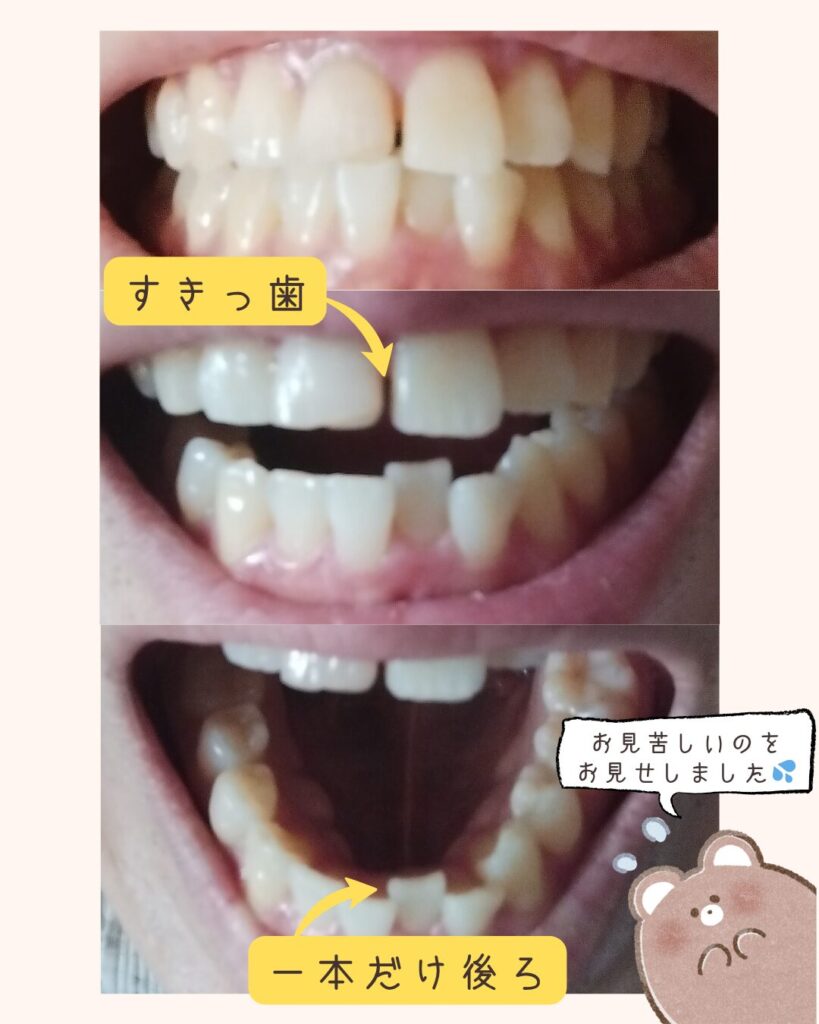 Oh my teeth矯正開始前の実際の歯並び写真。上の前歯のすきっ歯と、下の歯列で1本だけ後ろに下がっている歯列不正のコンプレックス。